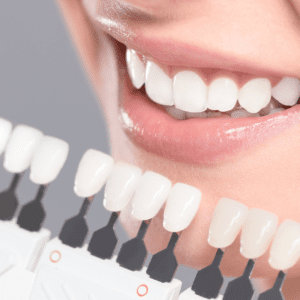 whitening dental lumineers