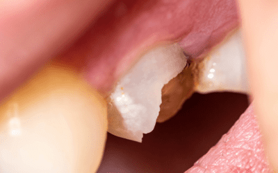 Chipped Tooth Katy: 1 Expert Repair and Restoration at Katy Family Smiles